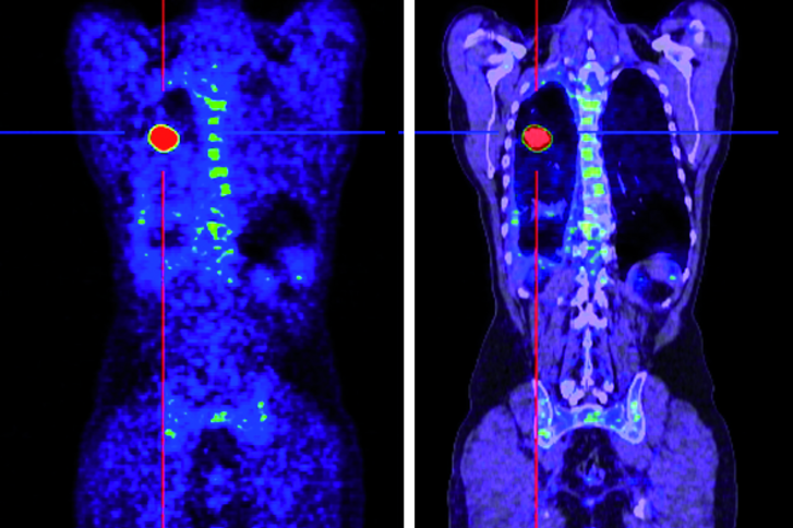Helios Berlin-Buch: Treatment of advanced-stage neuroendocrine tumor
